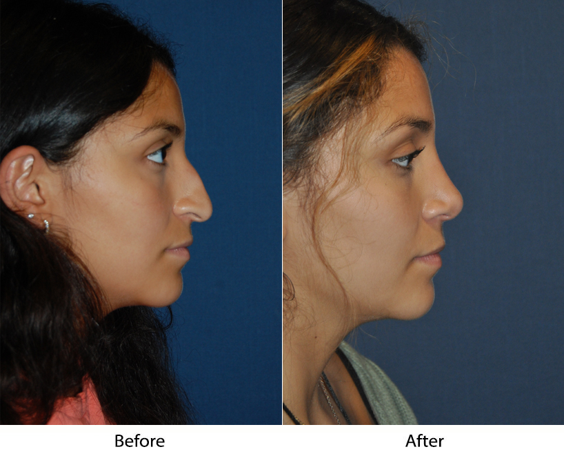 Ethnic Rhinoplasty by Charlotte's top nose job surgeon