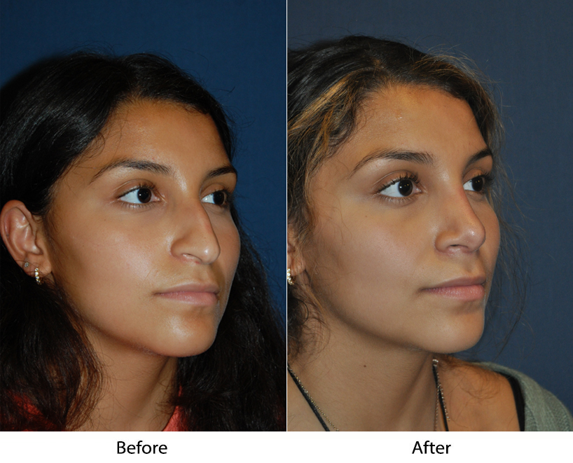 Rhinoplasty in Charlotte NC: prepare for your nose job