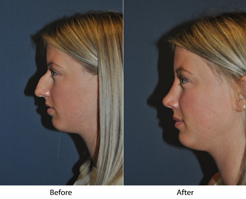 Nose job for medical and aesthetic reasons