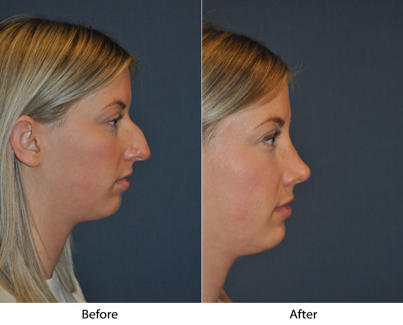Revision rhinoplasty offers hope