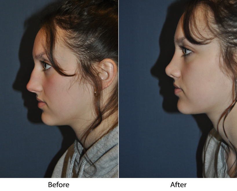 Best Charlotte Rhinoplasty surgeon, Dr. Sean Freeman of Only Faces, creates harmony and balance