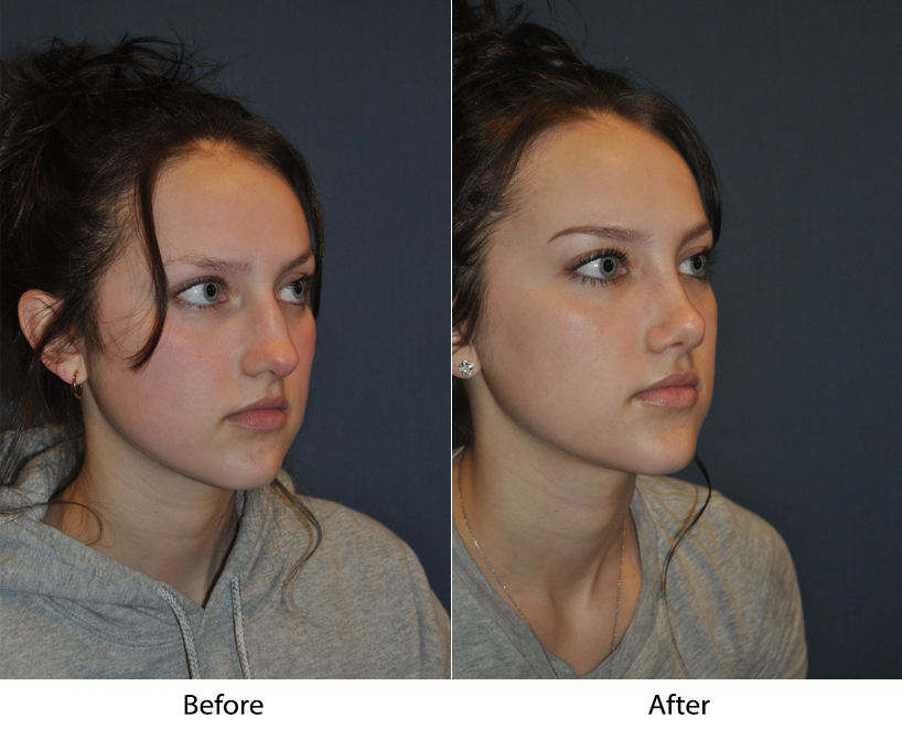 Revision rhinoplasty expert in Charlotte NC