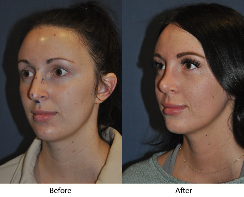 Rhinoplasty specialists in Charlotte: Find the top nose job surgeon