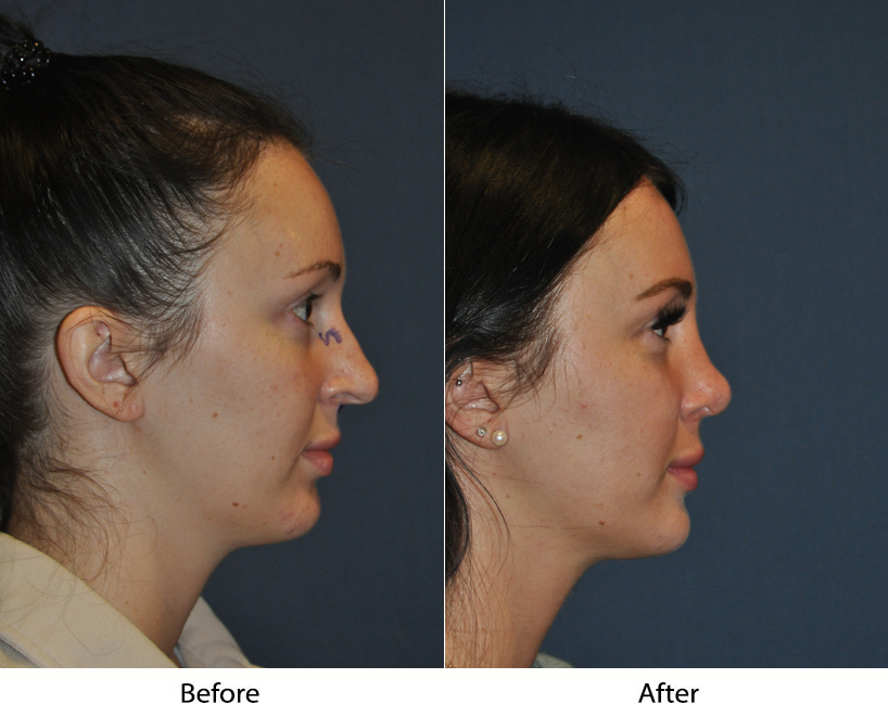 Best nose job surgeon by Charlotte's top nose surgeon
