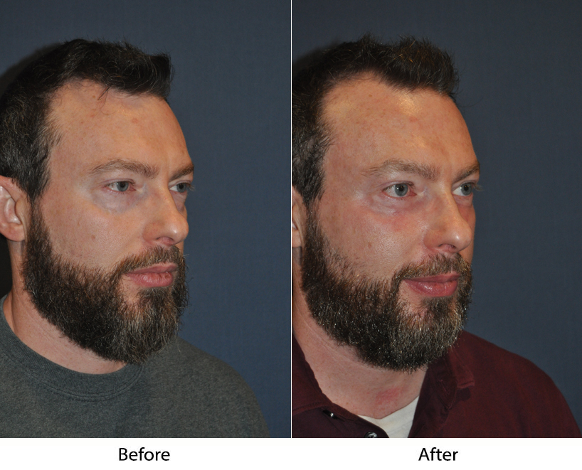 Facial plastic surgery procedures such as SOOF lift blepharoplasty can help self-esteem