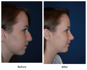Teen rhinoplasty surgery is the most requested cosmetic procedure by teens