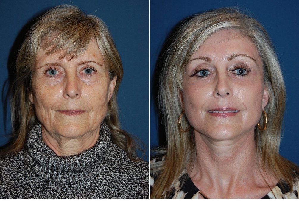 Eye Lid surgery from the best facial plastic surgeon in Charlotte