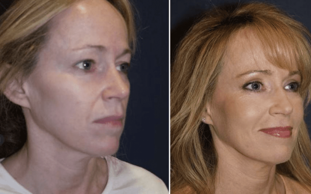 Can a Charlotte NC facial plastic surgeon resolve aging triads?
