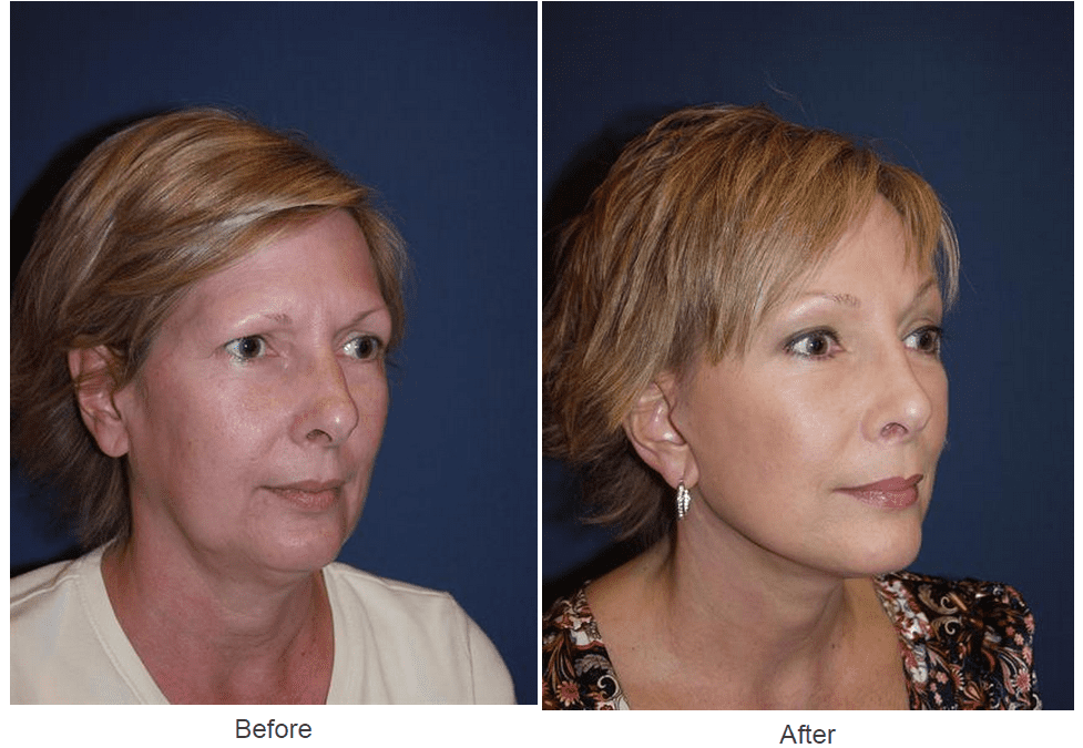Facelift Surgeon in Charlotte