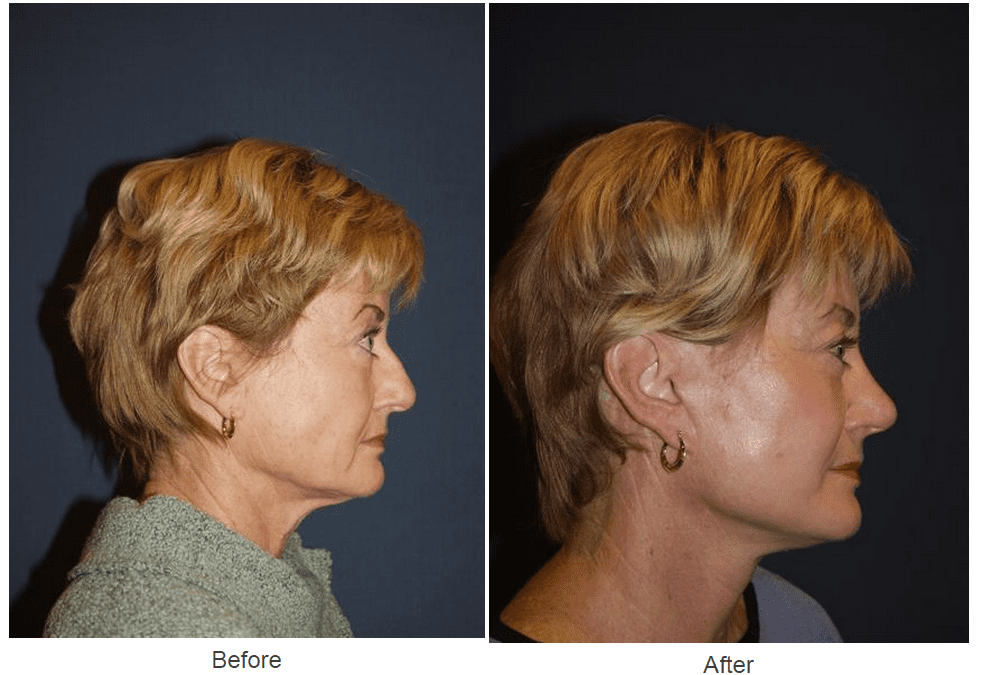Rhinoplasty surgeon in Charlotte explains common reasons for a nose job