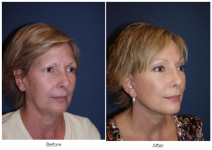 Look younger with a facelift