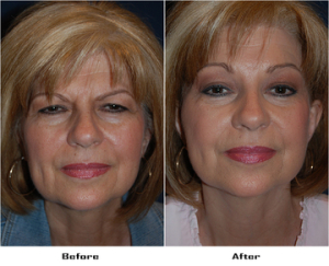 Brow lifts in Charlotte, NC can be medical or cosmetic