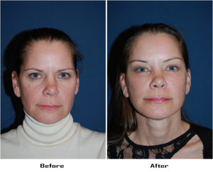 Brow lift surgery in Charlotte: what to expect from your top facial surgeon