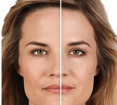 injectable fillers- before and after juvederm