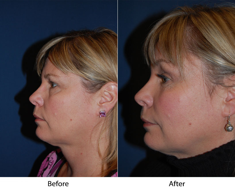 Brow lift surgery experts in Charlotte NC explains when to consider facial surgery
