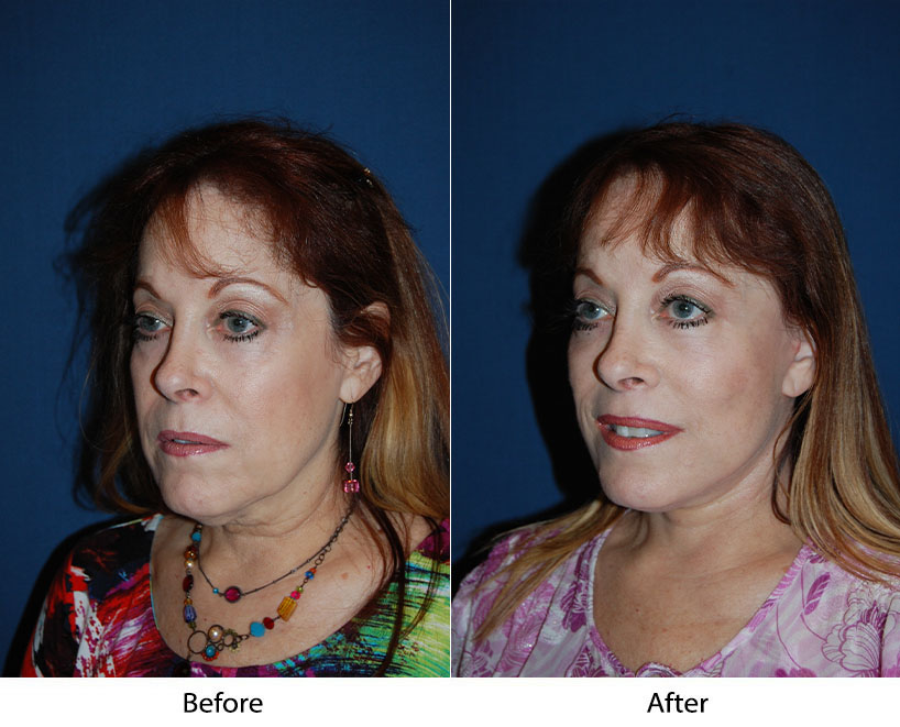 Soof Lift Blepharoplasty surgeon in Charlotte explains facts about the procedure