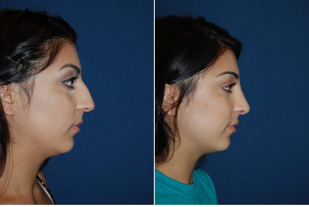 Charlotte’s top rhinoplasty expert explains managing shifted cartilage
