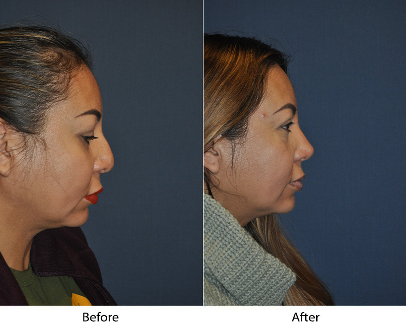 Charlotte’s top rhinoplasty expert offers recovery tips