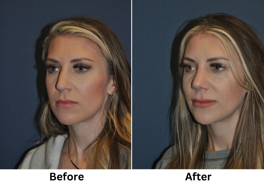 Charlotte’s Rhinoplasty Specialist – What You Need to Know