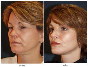 Charlotte’s Best Facelift Expert – All About Facelift Surgery