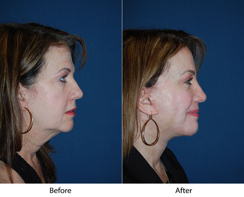 Charlotte’s Soof Lift Blepharoplasty Surgeon Recovery Guide