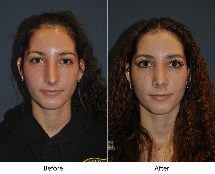 Charlotte’s Top Nose Job Surgeon: Glasses After Rhinoplasty?