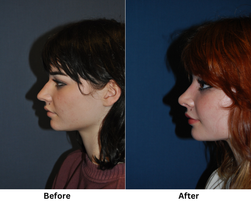 Rhinoplasty Specialist in Charlotte NC to Reduce Nose Fat