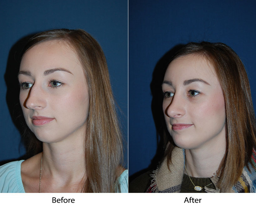 Charlotte’s Top Teen Rhinoplasty Surgeons Discusses Side Effects