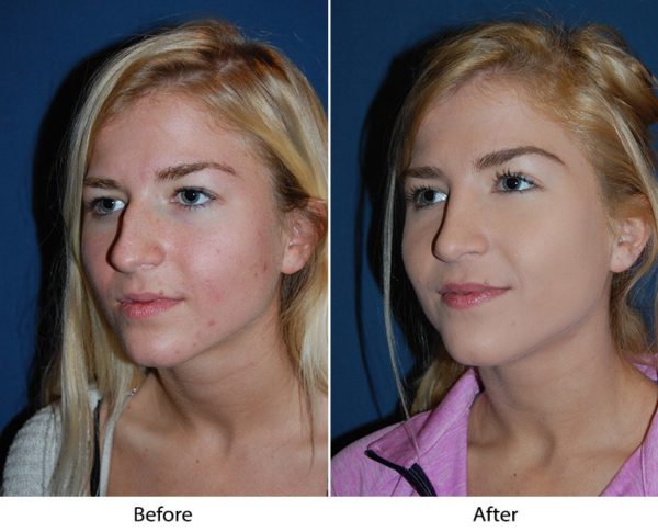 Best Charlotte rhinoplasty surgeons discusses signs of a nose job