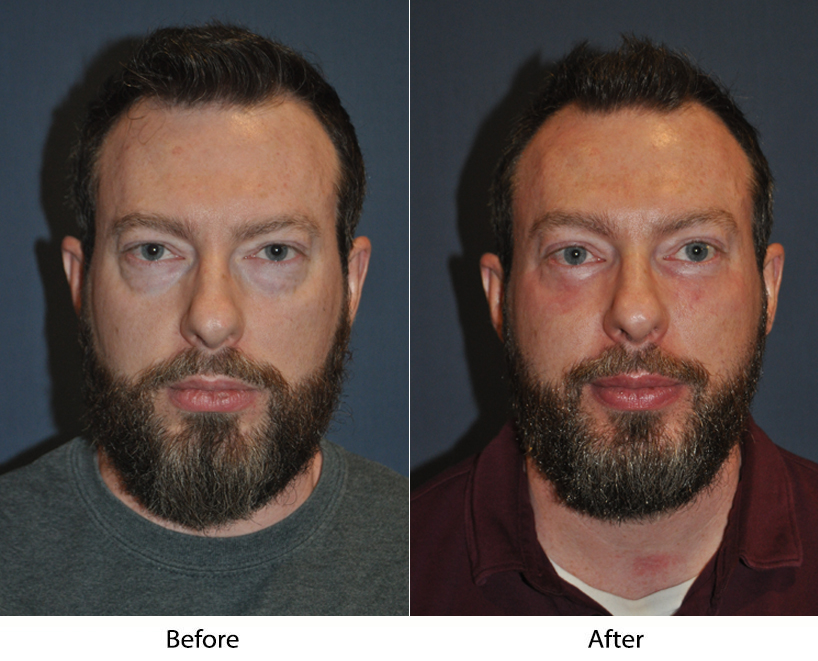 Best facial plastic surgeon in Charlotte NC: Post-Surgery Effects
