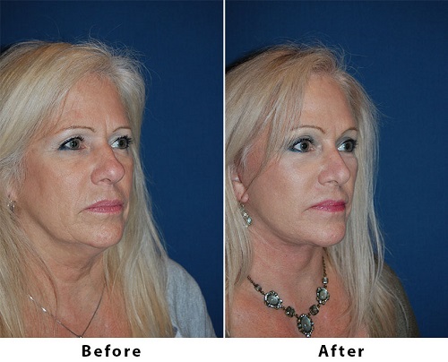 Segmental Endoscopic Brow Lift from Top Charlotte Facial Plastic Surgeon