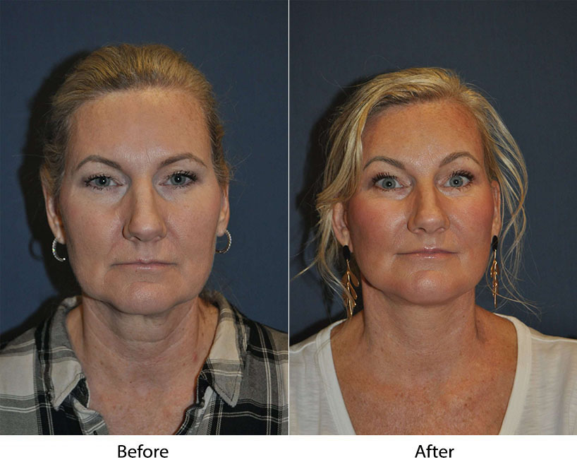 Soof Lift Blepharoplasty Common questions in Charlotte NC