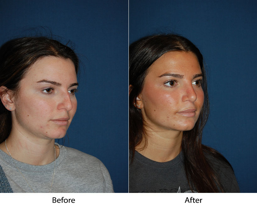 Charlotte’s Top Teen Rhinoplasty Surgeon Discusses Scarring
