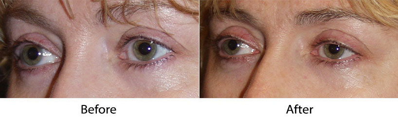 Charlotte’s Soof Lift Blepharoplasty Surgeon’s Facial Cleansing Tips