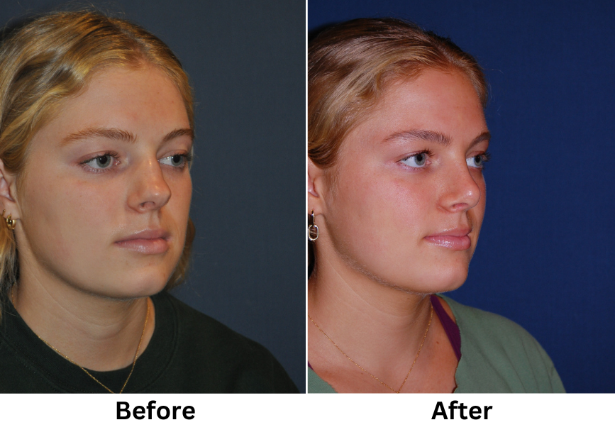 Charlotte’s Top Nose Job Surgeon for Nostril Reduction