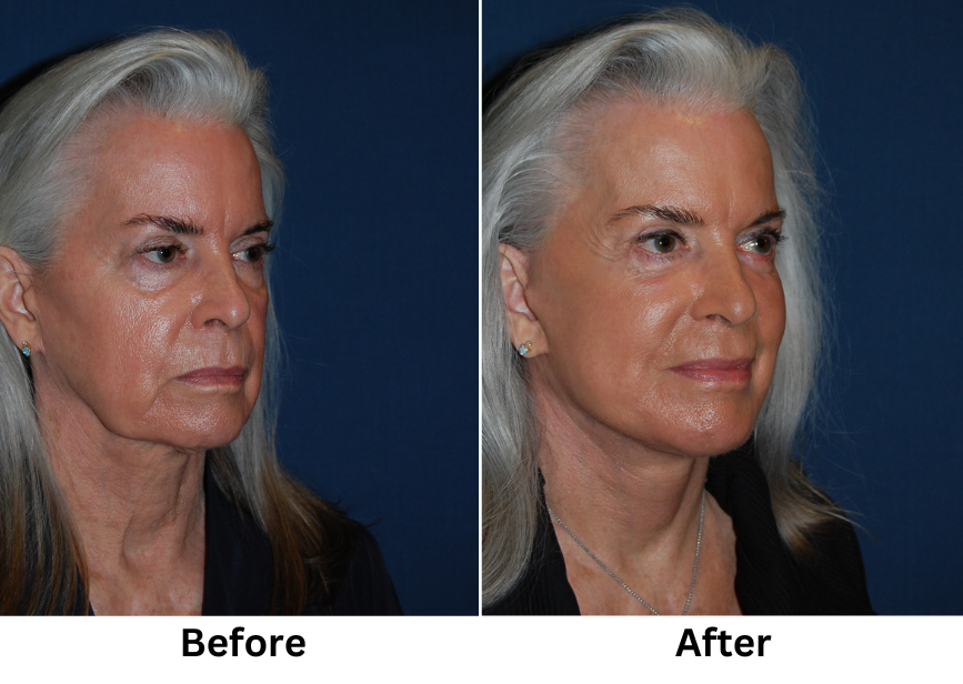 Segmental Endoscopic Brow Lift Effects and Benefits in Charlotte