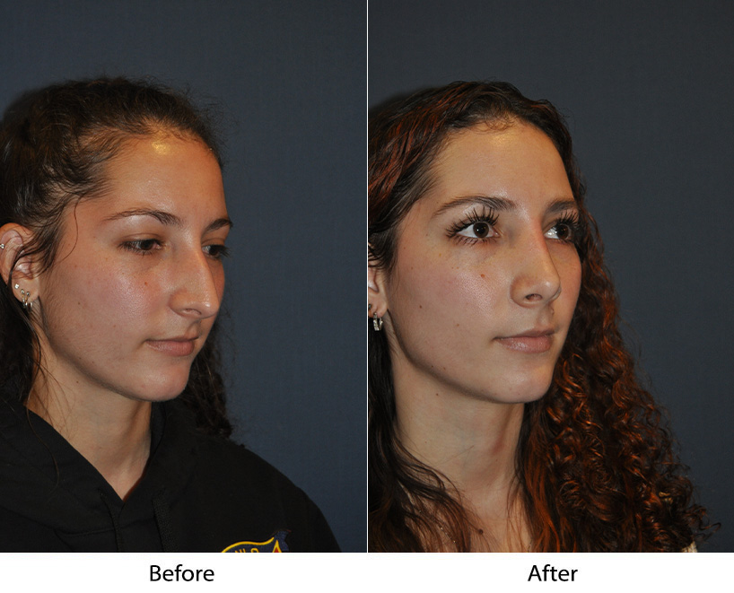 Charlotte’s Best Rhinoplasty Specialist for Mature Adults