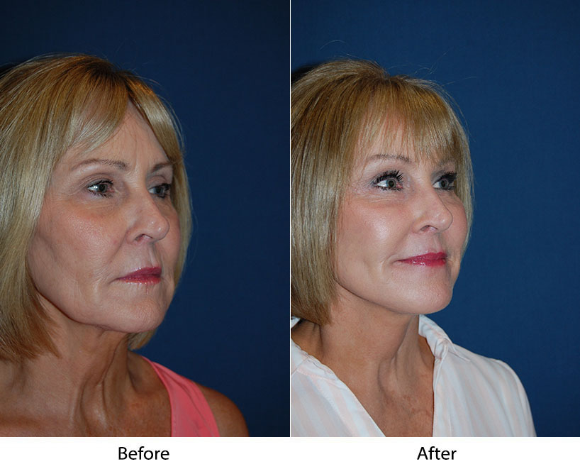 Segmental Endoscopic Brow Lift Long Term Results in Charlotte NC