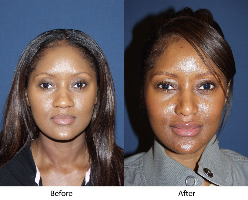 Rhinoplasty specialist in Charlotte on Alar Rim Deformities