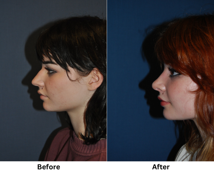 Top Rhinoplasty Specialist In Charlotte: Artistry In Action