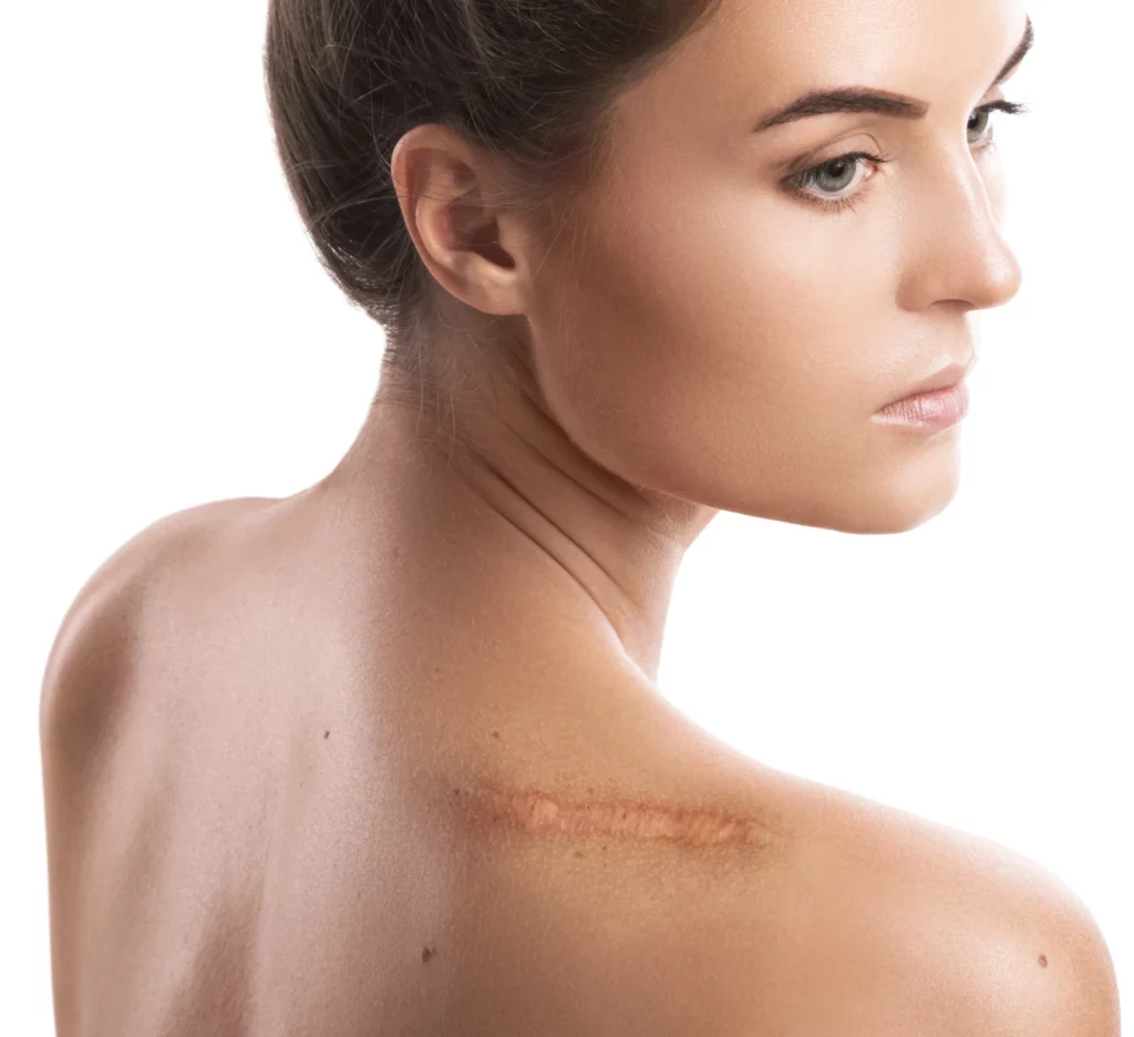 Surgical Scar Revision A Step-by-Step Guide banner