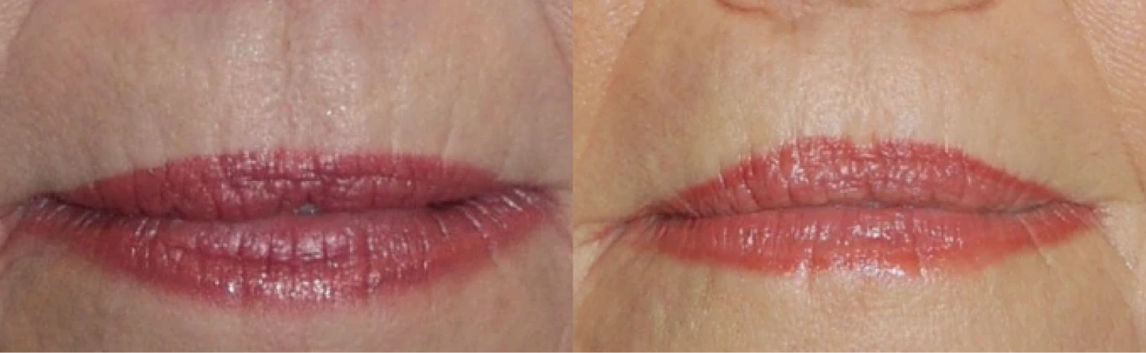 Lip Implant Before and After Banner