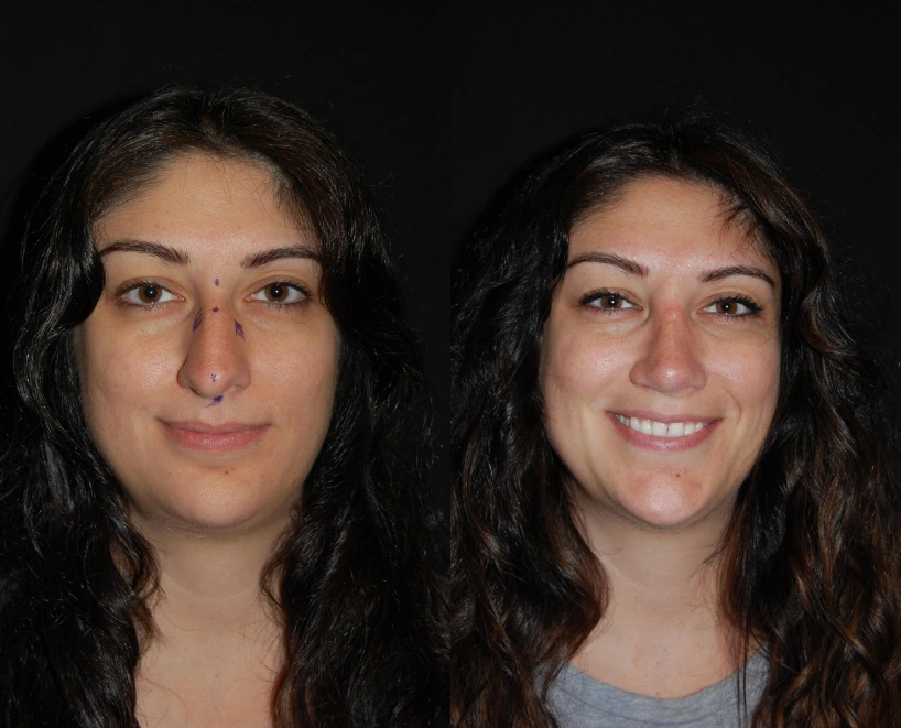 Rhinoplasty (1)